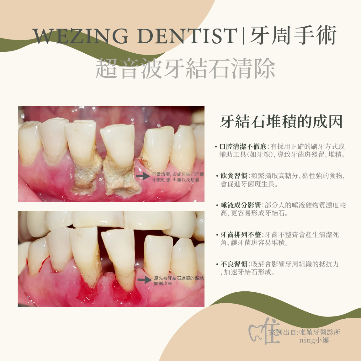 牙結石堆積造成牙周病